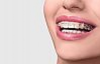 Diş Teli Hakkında Yanlış Bilinenler